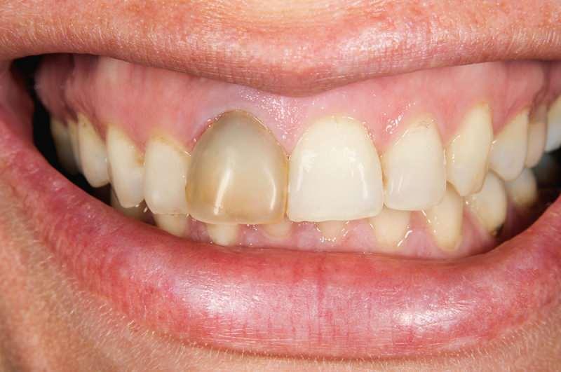 diş kararması bazen bir dişte yoğunlaşabilir