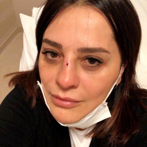 Ünlü şarkıcı Reyhan Karaca bahçeden düşüp burnunu kırdı!