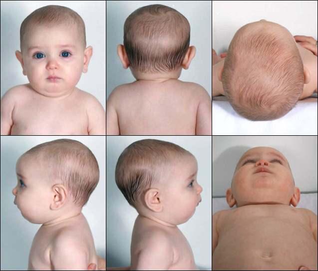 bebeklerde kafatası şekil bozukluğu nedir?