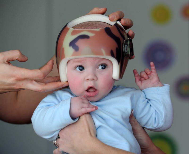 bebeklerde kask tedavisi nedir?