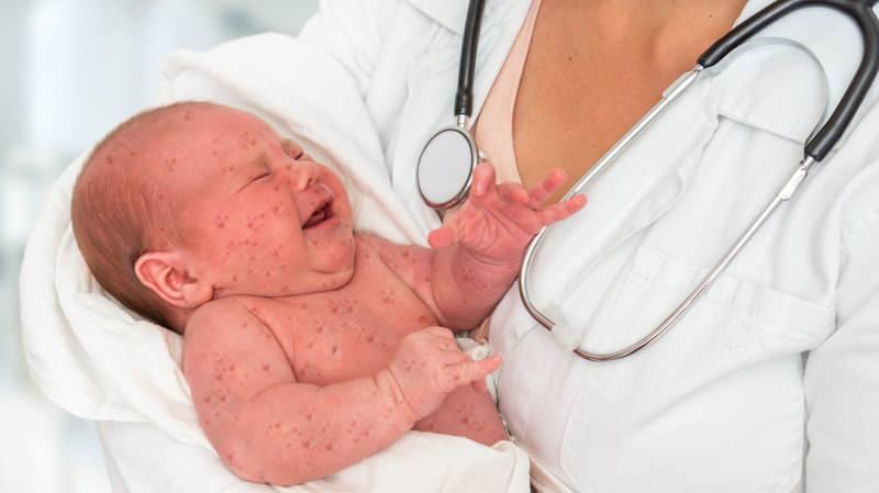 Bebeklerde kızamık aşısı
